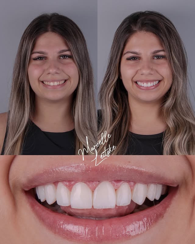 Antes e depois — Naturalidade